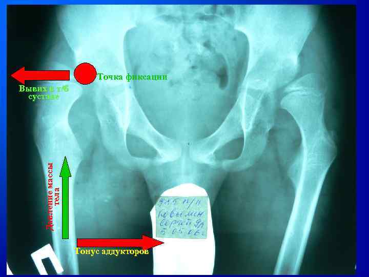 Точка фиксации Давление массы тела Вывих в т/б суставе Тонус аддукторов 