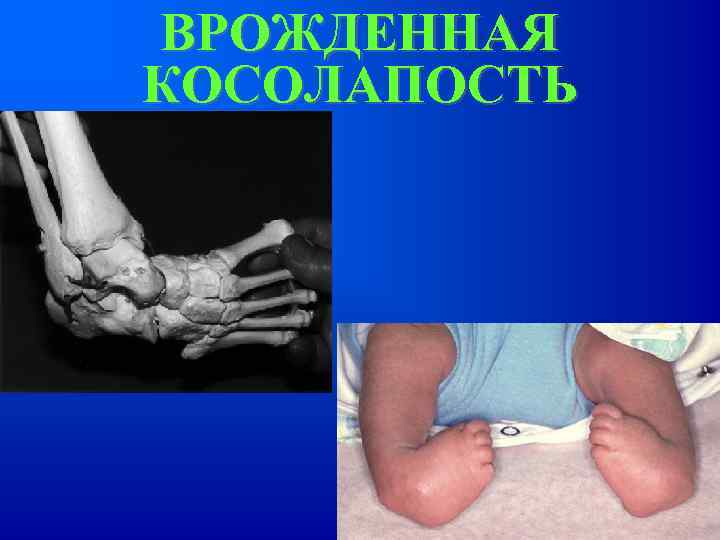 ВРОЖДЕННАЯ КОСОЛАПОСТЬ 