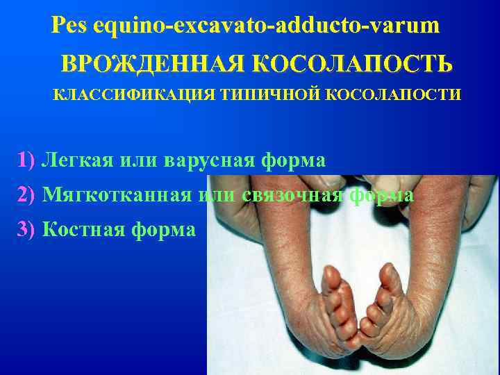 Pes equino-excavato-adducto-varum ВРОЖДЕННАЯ КОСОЛАПОСТЬ КЛАССИФИКАЦИЯ ТИПИЧНОЙ КОСОЛАПОСТИ 1) Легкая или варусная форма 2) Мягкотканная