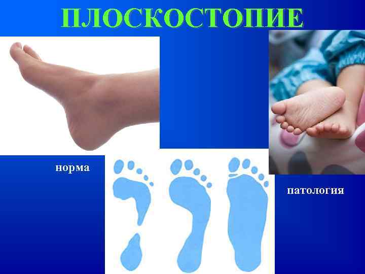 ПЛОСКОСТОПИЕ норма патология 