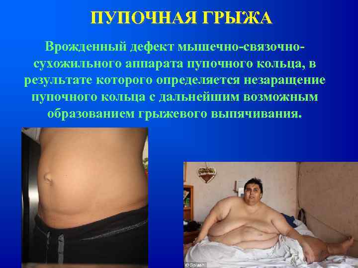 ПУПОЧНАЯ ГРЫЖА Врожденный дефект мышечно-связочносухожильного аппарата пупочного кольца, в результате которого определяется незаращение пупочного