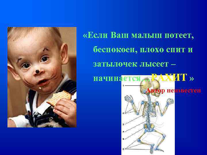  «Если Ваш малыш потеет, беспокоен, плохо спит и затылочек лысеет – начинается… РАХИТ