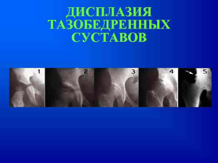 ДИСПЛАЗИЯ ТАЗОБЕДРЕННЫХ СУСТАВОВ 