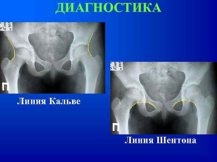 ДИАГНОСТИКА Линия Кальве Линия Шентона 