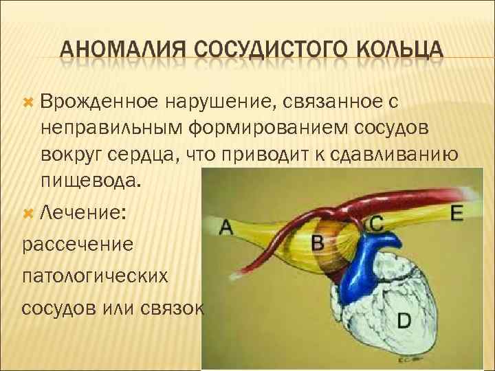  Врожденное нарушение, связанное с неправильным формированием сосудов вокруг сердца, что приводит к сдавливанию