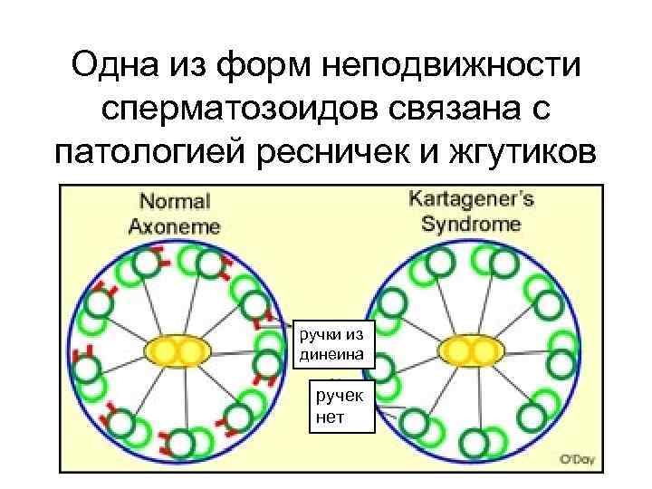 Одна из форм неподвижности сперматозоидов связана с патологией ресничек и жгутиков ручки из динеина