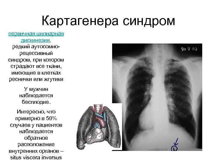 Картагенера синдром первичная цилиарная дискинезия, редкий аутосомнорецессивный синдром, при котором страдают все ткани, имеющие