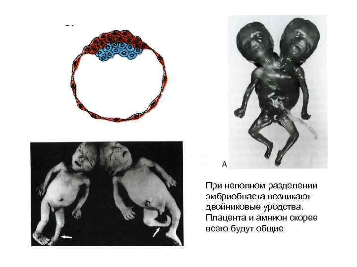 При неполном разделении эмбриобласта возникают двойниковые уродства. Плацента и амнион скорее всего будут общие