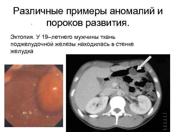 Различные примеры аномалий и пороков развития. Эктопия. У 19–летнего мужчины ткань поджелудочной железы находилась