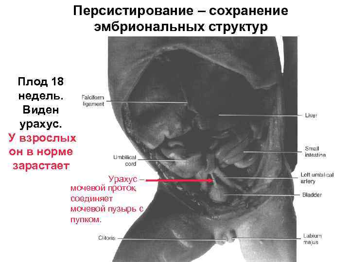 Персистирование – сохранение эмбриональных структур Плод 18 недель. Виден урахус. У взрослых он в