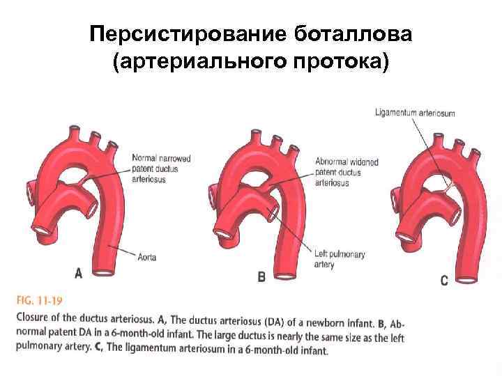 Персистирование боталлова (артериального протока) 