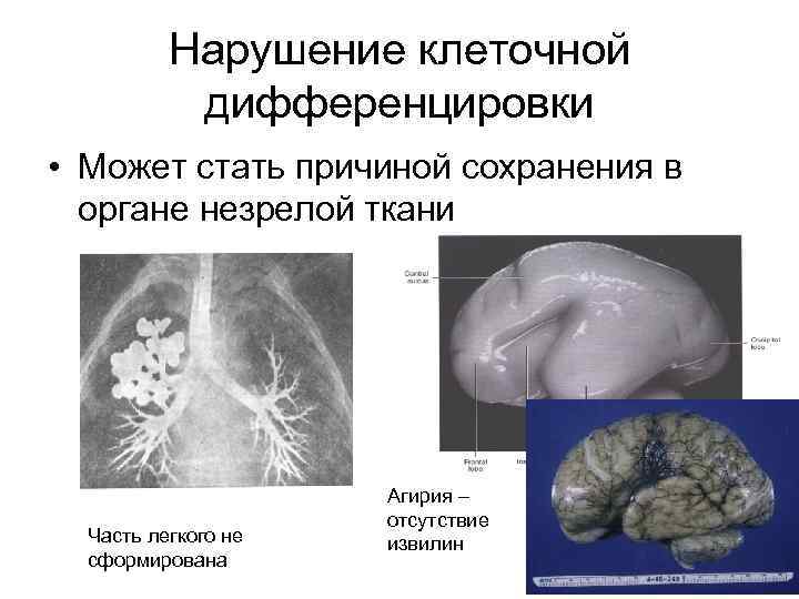 Нарушение клеточной дифференцировки • Может стать причиной сохранения в органе незрелой ткани Часть легкого