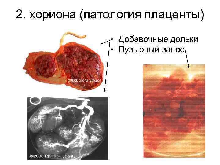 2. хориона (патология плаценты) • Добавочные дольки • Пузырный занос 