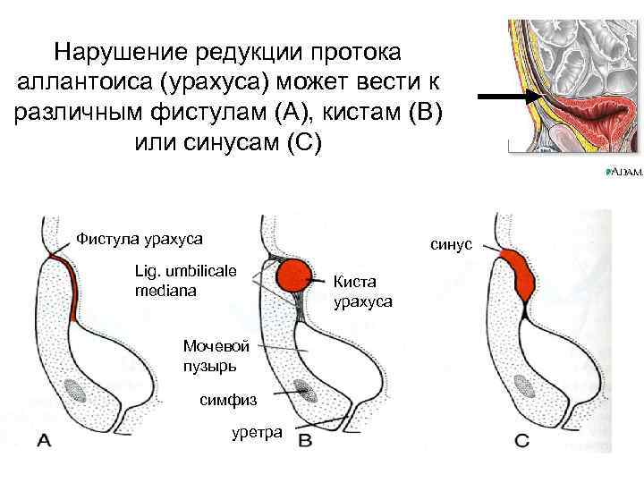 Нарушение редукции протока аллантоиса (урахуса) может вести к различным фистулам (А), кистам (В) или