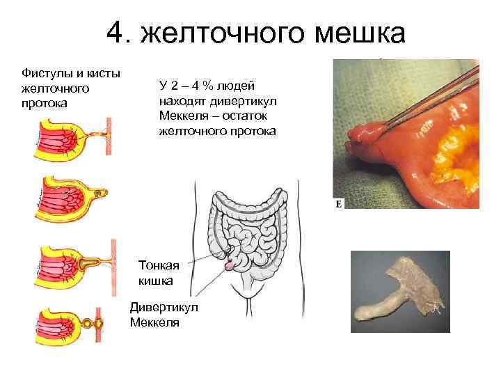 4. желточного мешка Фистулы и кисты желточного протока У 2 – 4 % людей