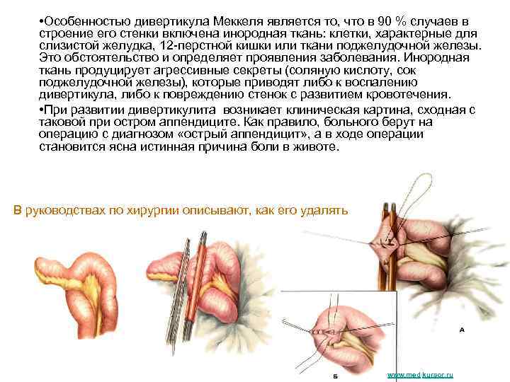  • Особенностью дивертикула Меккеля является то, что в 90 % случаев в строение