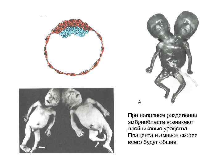 При неполном разделении эмбриобласта возникают двойниковые уродства. Плацента и амнион скорее всего будут общие