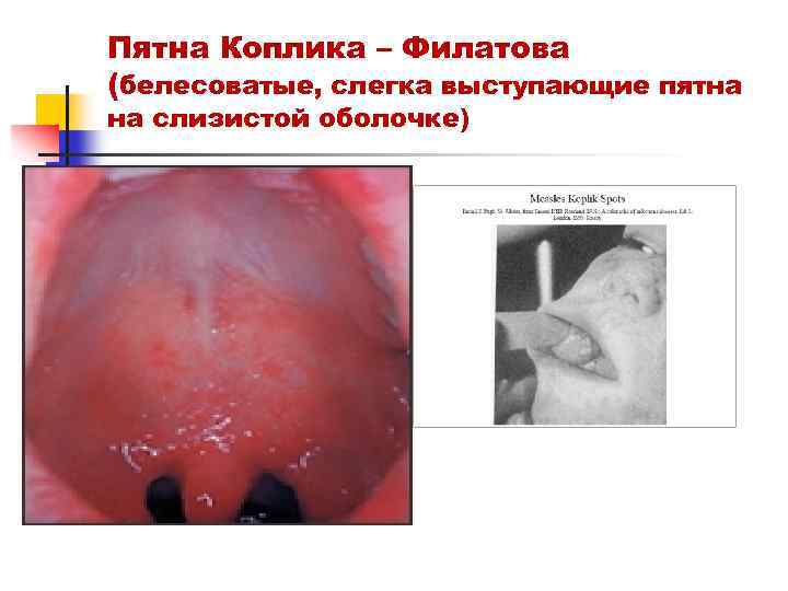 Пятна Коплика – Филатова (белесоватые, слегка выступающие пятна на слизистой оболочке) 