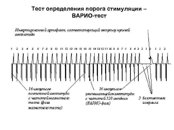 Тест определения порога стимуляции – ВАРИО-тест 