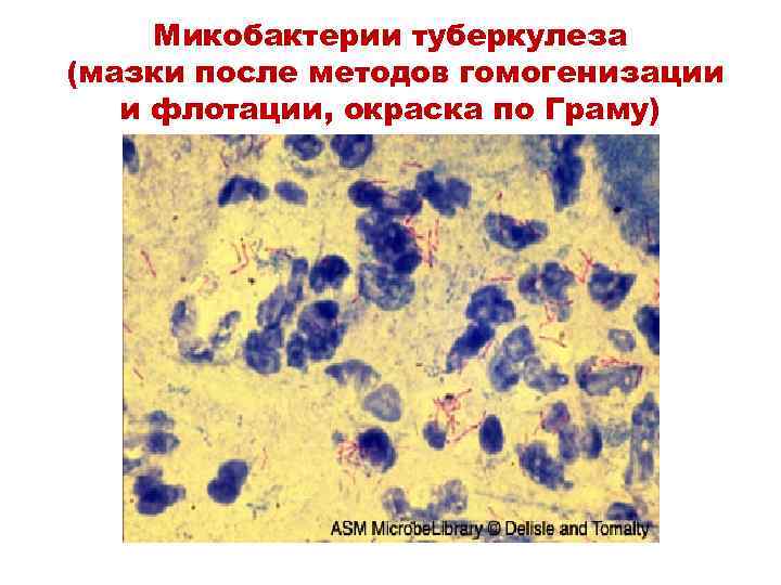 Микобактерии туберкулеза (мазки после методов гомогенизации и флотации, окраска по Граму) 
