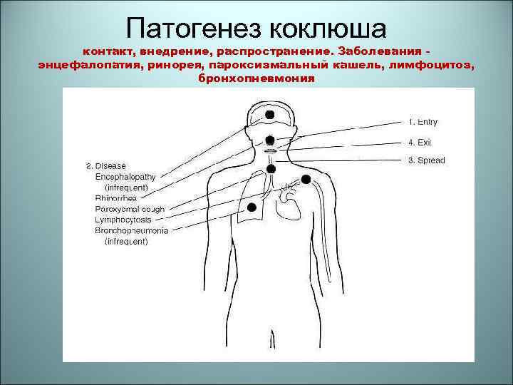 Патогенез коклюша контакт, внедрение, распространение. Заболевания энцефалопатия, ринорея, пароксизмальный кашель, лимфоцитоз, бронхопневмония 