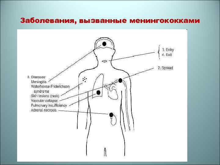 Заболевания, вызванные менингококками 