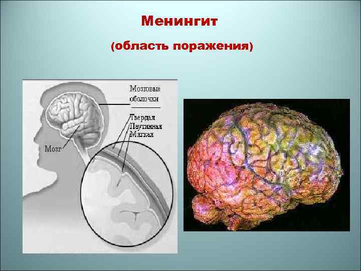 Менингит (область поражения) 