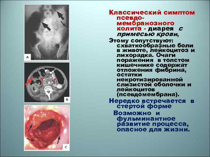 Классический симптом псевдомембранозного колита - диарея с примесью крови, Этому сопутствуют: схваткообразные боли в