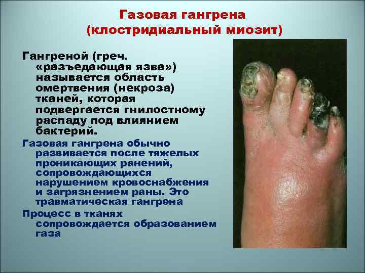 Газовая гангрена (клостридиальный миозит) Гангреной (греч. «разъедающая язва» ) называется область омертвения (некроза) тканей,