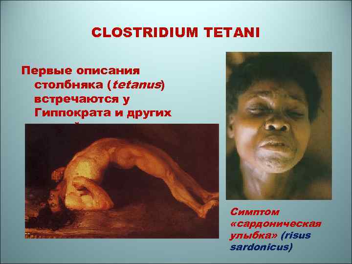 CLOSTRIDIUM TETANI Первые описания столбняка (tetanus) встречаются у Гиппократа и других врачей древности Симптом