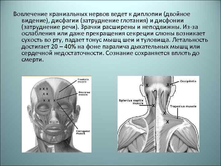 Вовлечение краниальных нервов ведет к диплопии (двойное видение), дисфагии (затруднение глотания) и дисфонии (затруднение