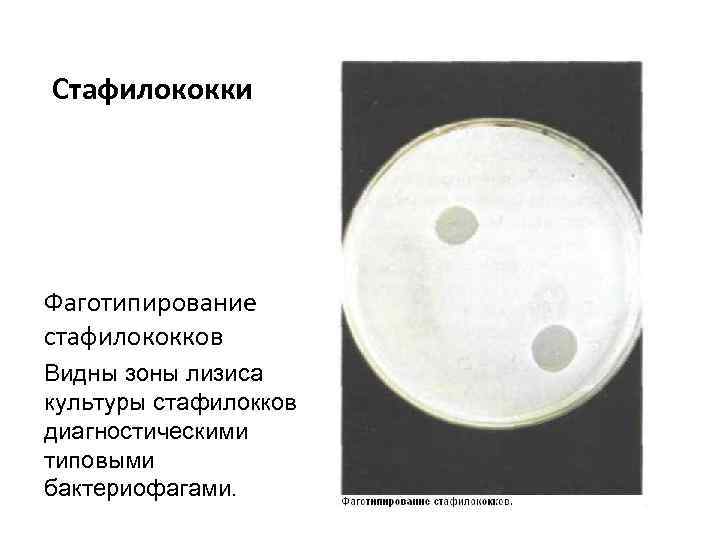 Стафилококки Фаготипирование стафилококков Видны зоны лизиса культуры стафилокков диагностическими типовыми бактериофагами. 