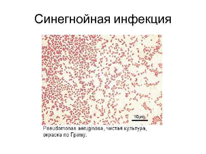 Синегнойная инфекция 