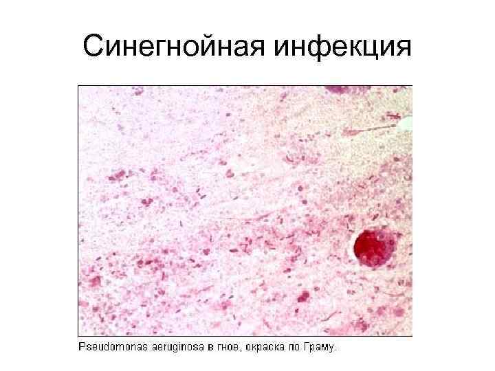 Синегнойная инфекция 