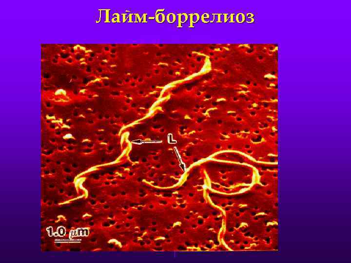 Лайм-боррелиоз 