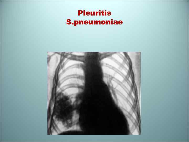 Pleuritis S. pneumoniae 