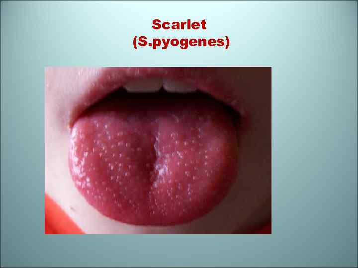 Scarlet (S. pyogenes) 