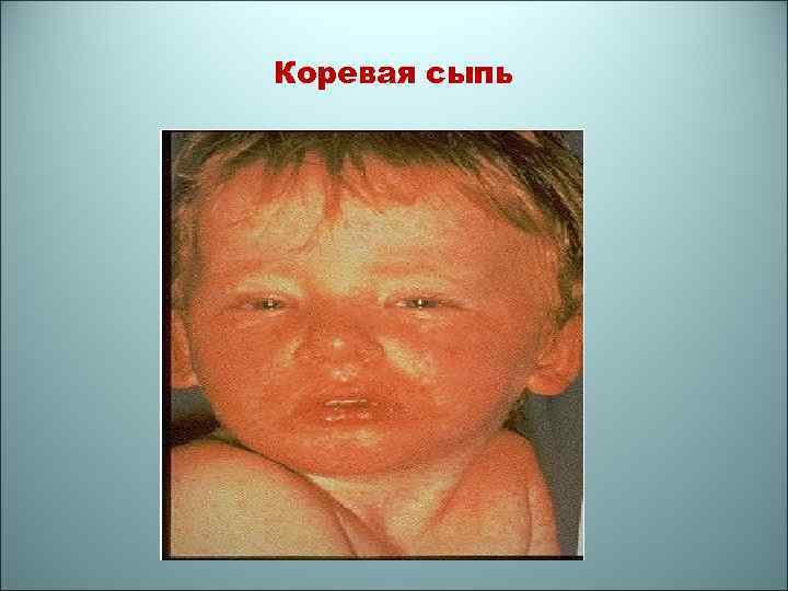 Коревая сыпь 