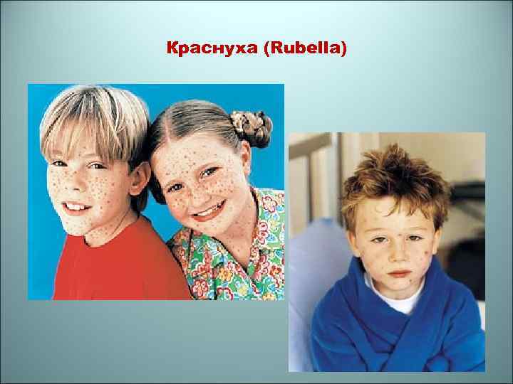 Краснуха (Rubella) 