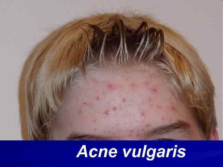 Acne vulgaris 