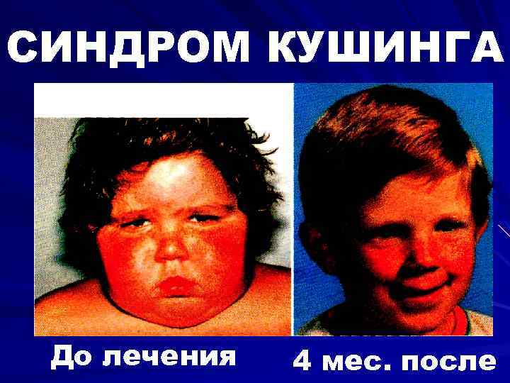 СИНДРОМ КУШИНГА До лечения 4 мес. после 