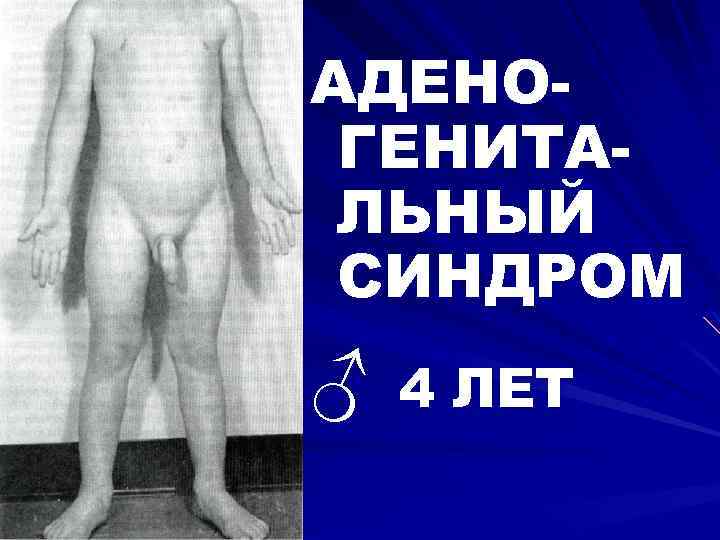 АДЕНОГЕНИТАЛЬНЫЙ СИНДРОМ ♂ 4 ЛЕТ 