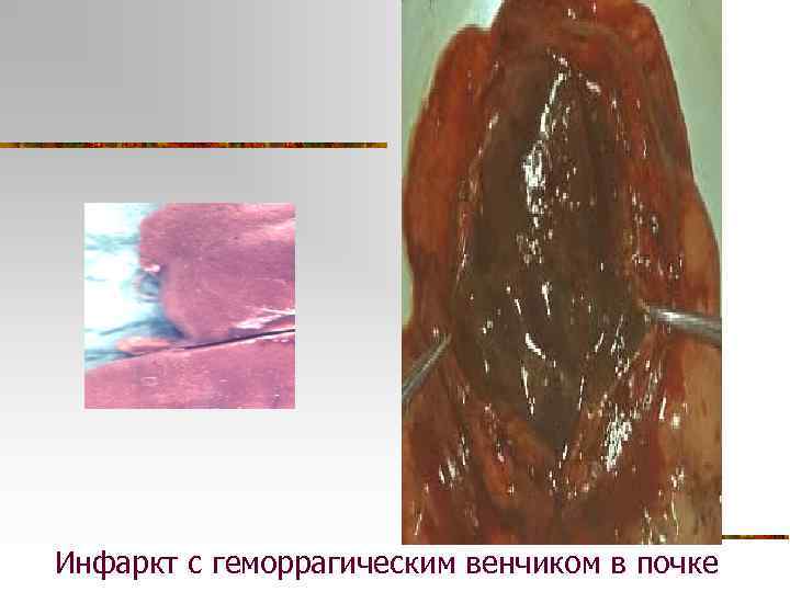 Инфаркт с геморрагическим венчиком в почке 