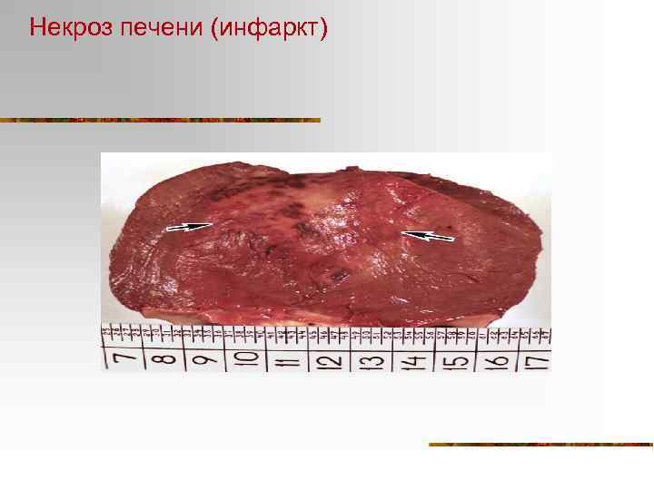 Некроз печени (инфаркт) 