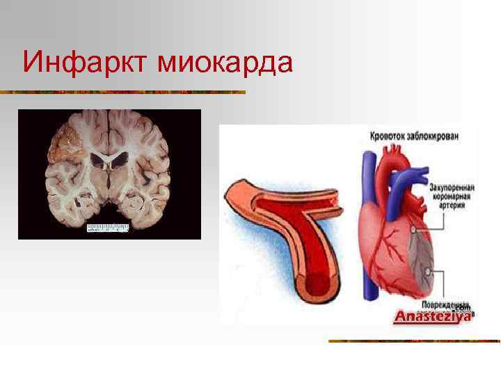 Инфаркт миокарда 