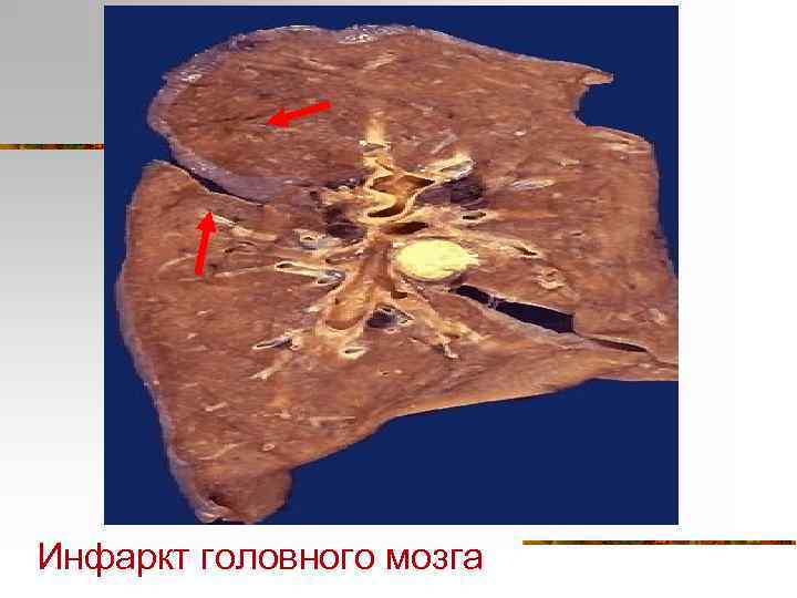 Инфаркт головного мозга 