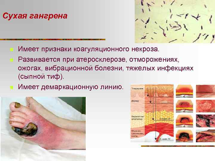 Сухая гангрена n n n Имеет признаки коагуляционного некроза. Развивается при атеросклерозе, отморожениях, ожогах,