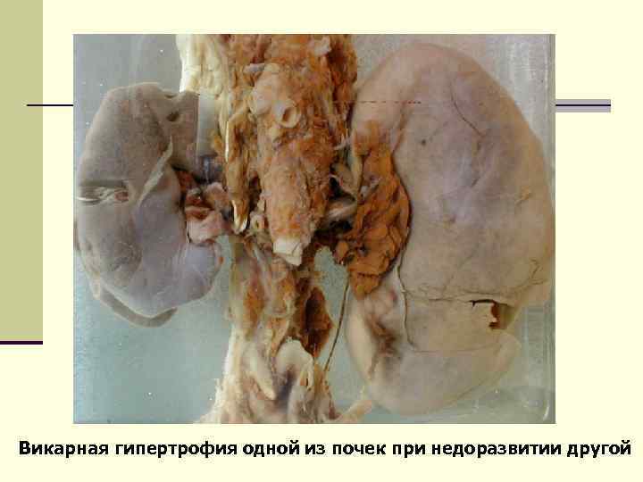Викарная гипертрофия одной из почек при недоразвитии другой 