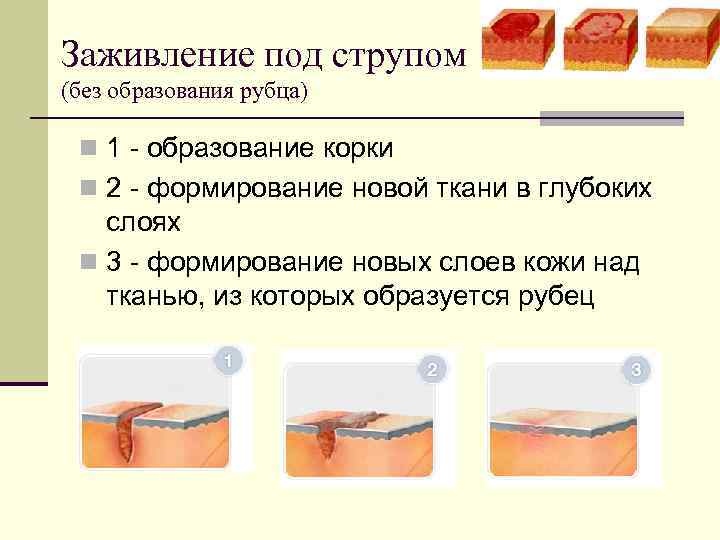 Заживление под струпом (без образования рубца) n 1 - образование корки n 2 -