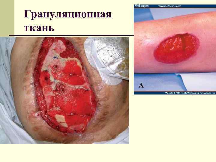 Грануляционная ткань 